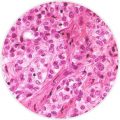 Epithelial mesothelioma cell