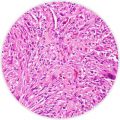 Sarcomatoid mesothelioma cell