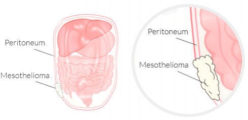 Mesothelioma tumors on the peritoneum